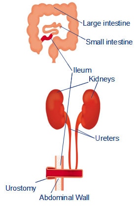 Urostomi