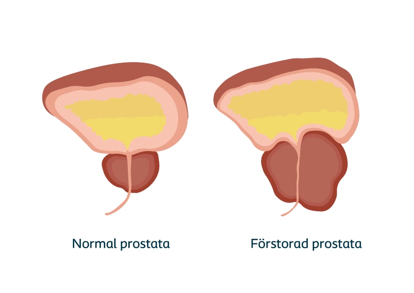 Förstorad Prostata illustration