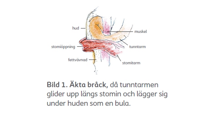 Bråck